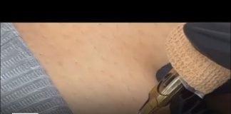 How a Pasadena tattoo shop is helping people with physical injuries heal